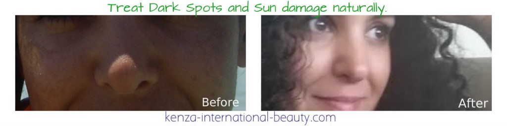 Treat Dark Spots and Sun damage naturally 